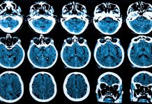 huntington's disease research, cell biology