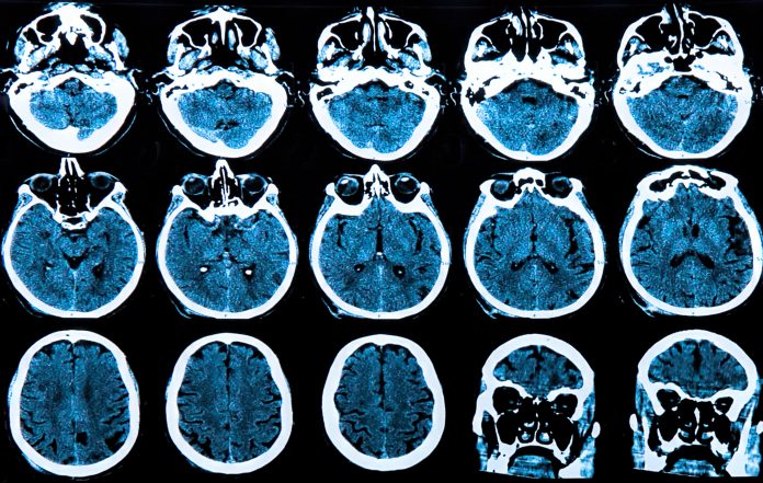 huntington's disease research, cell biology