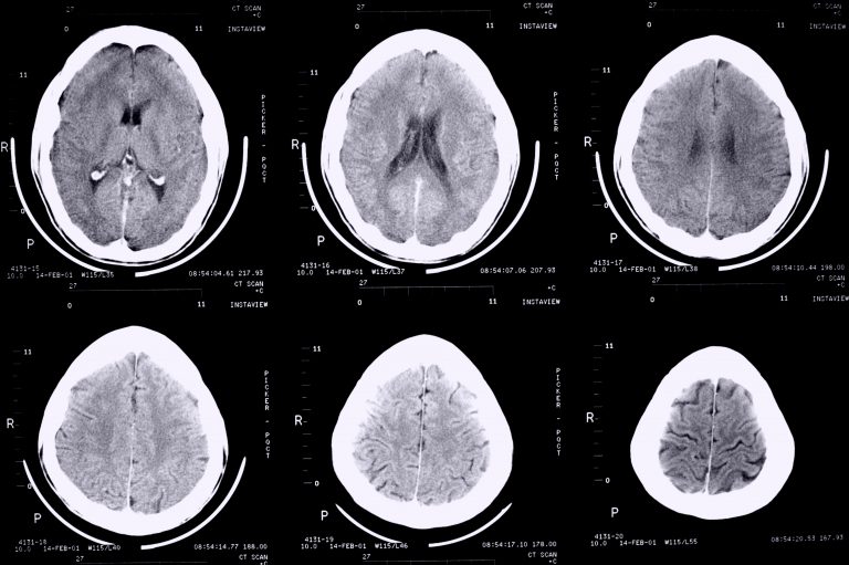 treatment for epilepsy, neuron