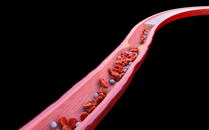 endothelium and long COVID, long COVID