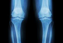 innovation in biomechanics, osteoarthritis