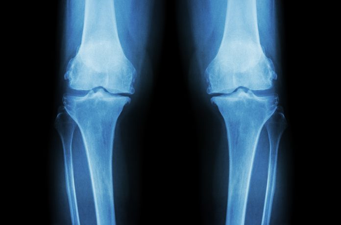 innovation in biomechanics, osteoarthritis