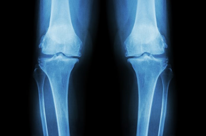 innovation in biomechanics, osteoarthritis