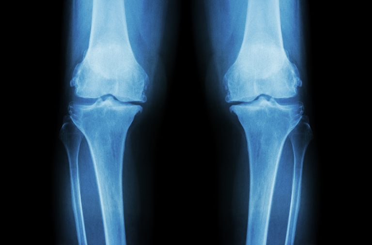 innovation in biomechanics, osteoarthritis