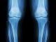 innovation in biomechanics, osteoarthritis