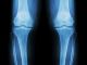 innovation in biomechanics, osteoarthritis