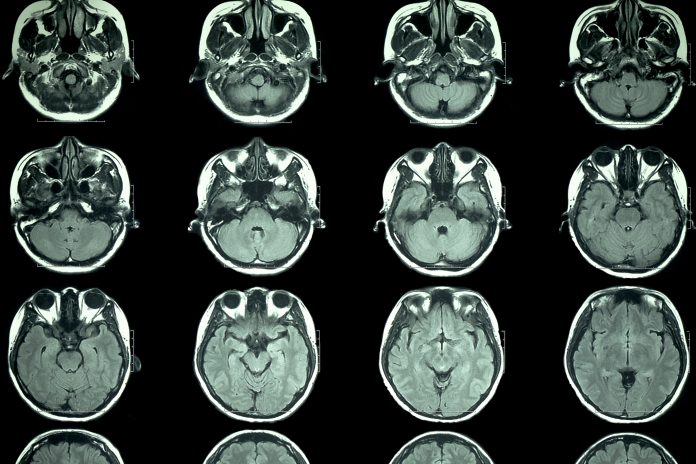 mild covid cases, fatigue