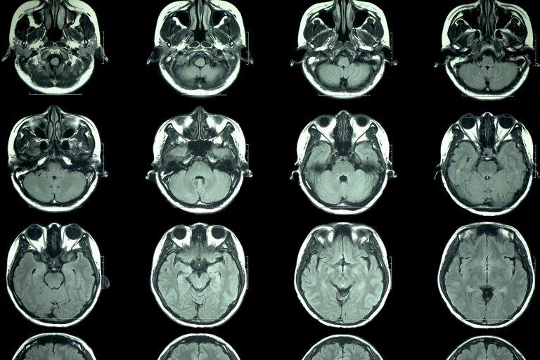 mild covid cases, fatigue