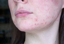 treatment for acne rosacea