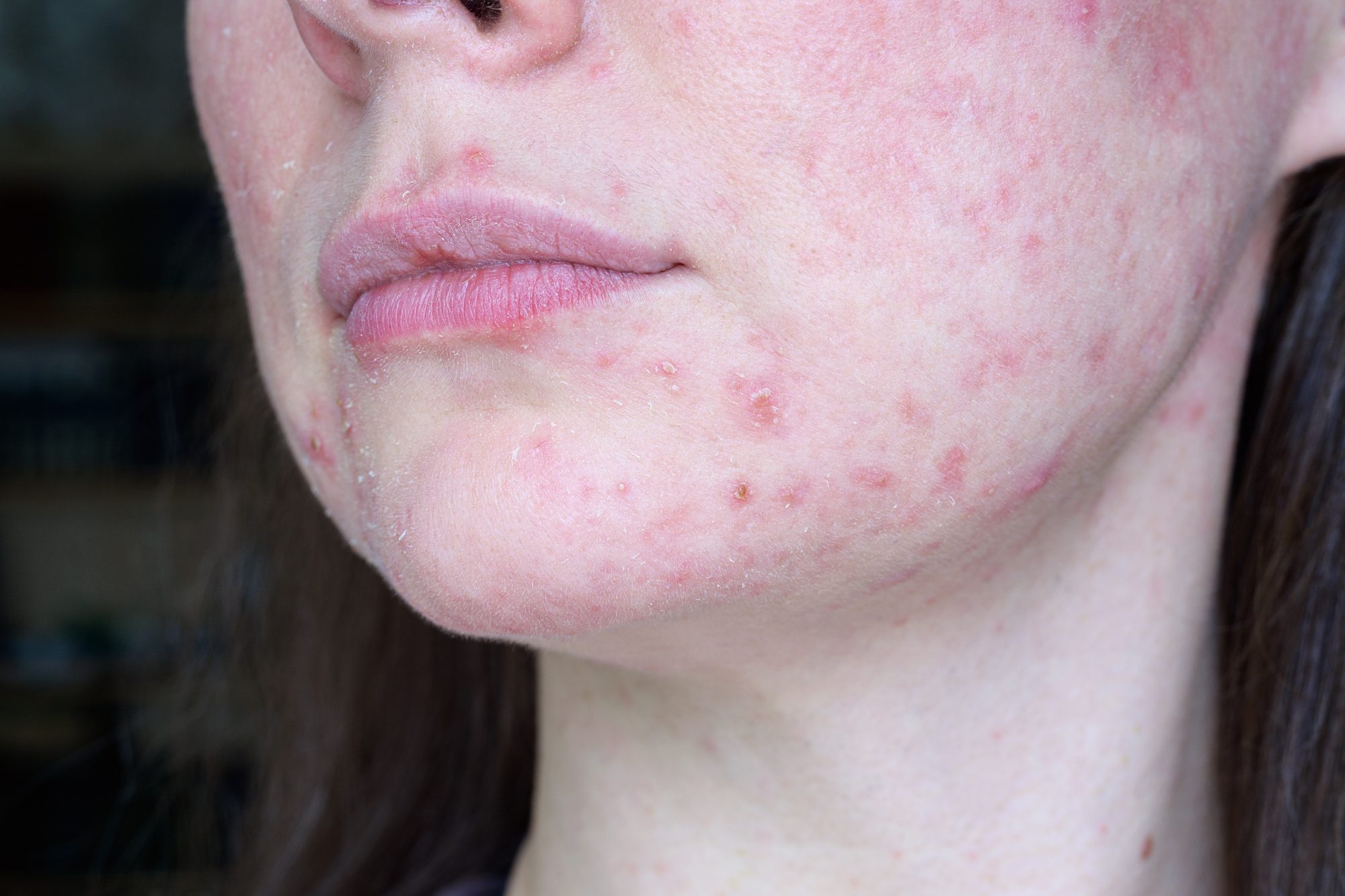 غزل قبر يعني  Metrogel and rosex gel as a treatment for acne rosacea