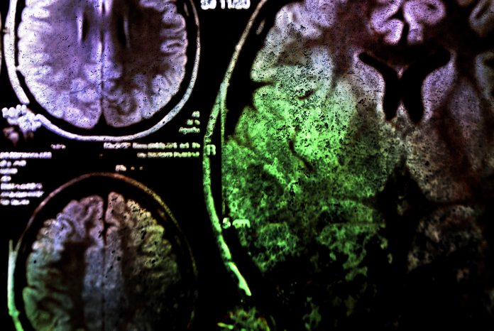 brain tumour diagnosis