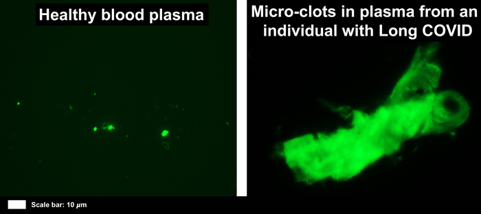 blood clot long covid, long covid side effect