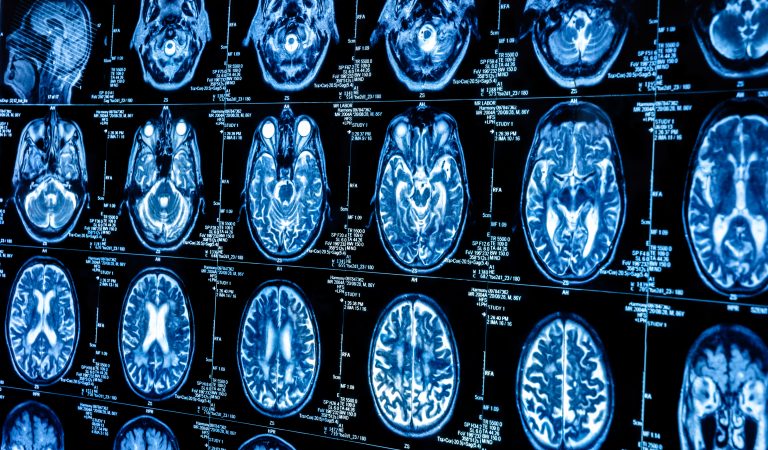 miRNAs in brain cancer therapy