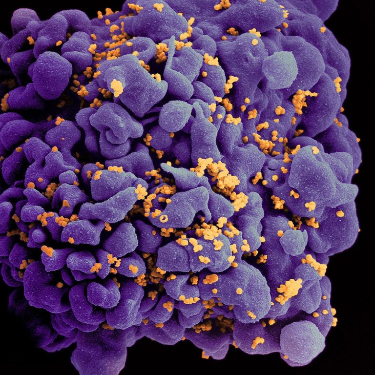 Third known case of HIV remission after stem cell transplant