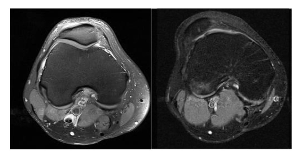 trochlear dysplasia