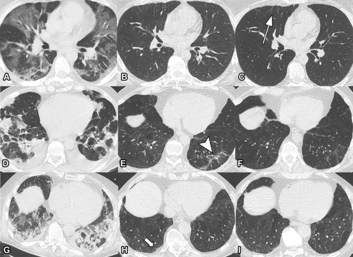 covid-19 pneumonia, covid-19