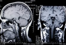 brain tumours and seizures, epilepsy research UK