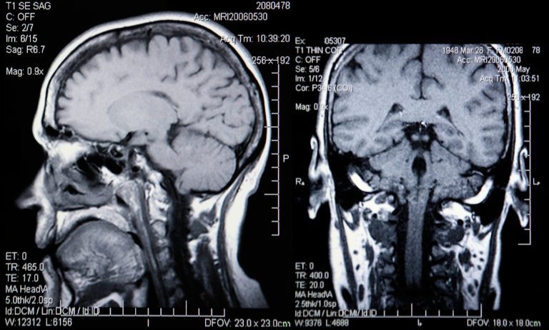 brain tumours and seizures, epilepsy research UK