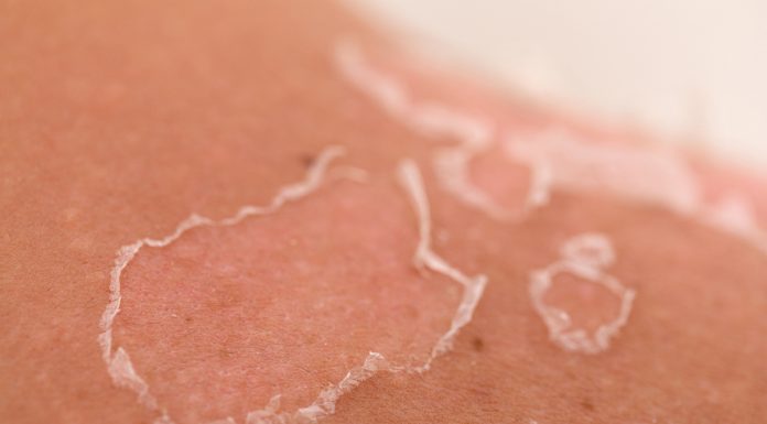 scientific sunburn