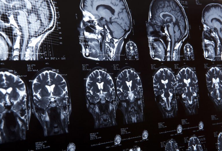 lethal brain tumour, glioblastoma