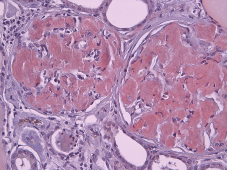 amyloid, membrane channels structures