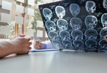 outcomes for stroke patients, AI