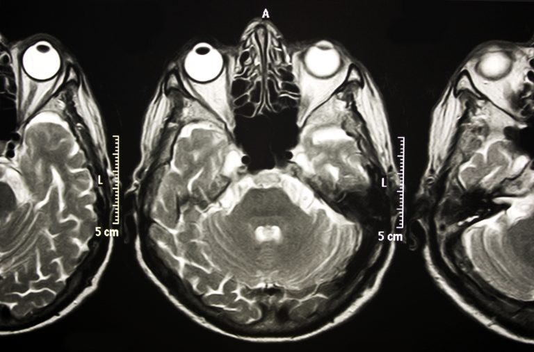 preclinical alzheimer's disease, novel marker