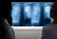 beating lung cancer, ai