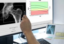 brittle bone disease, osteogenesis imperfecta type I