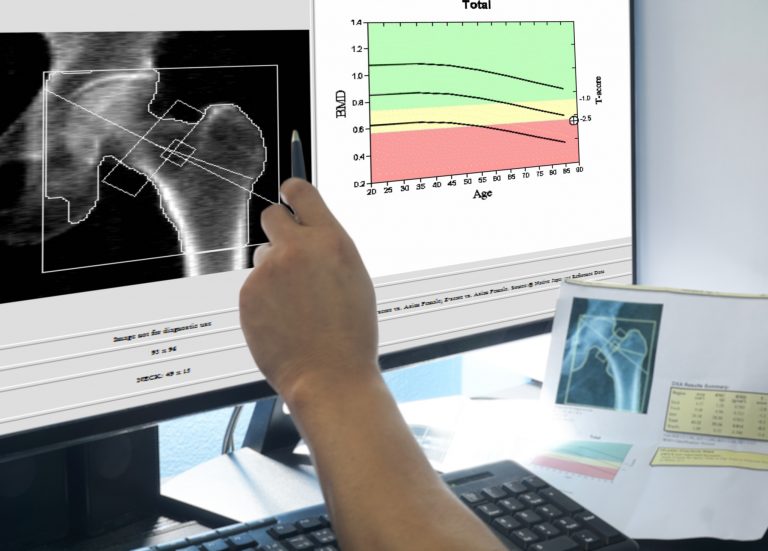 brittle bone disease, osteogenesis imperfecta type I