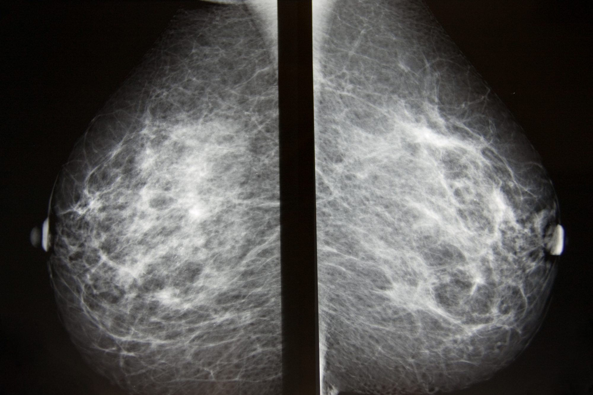 Using AI to deliver high quality, personalised breast cancer screening