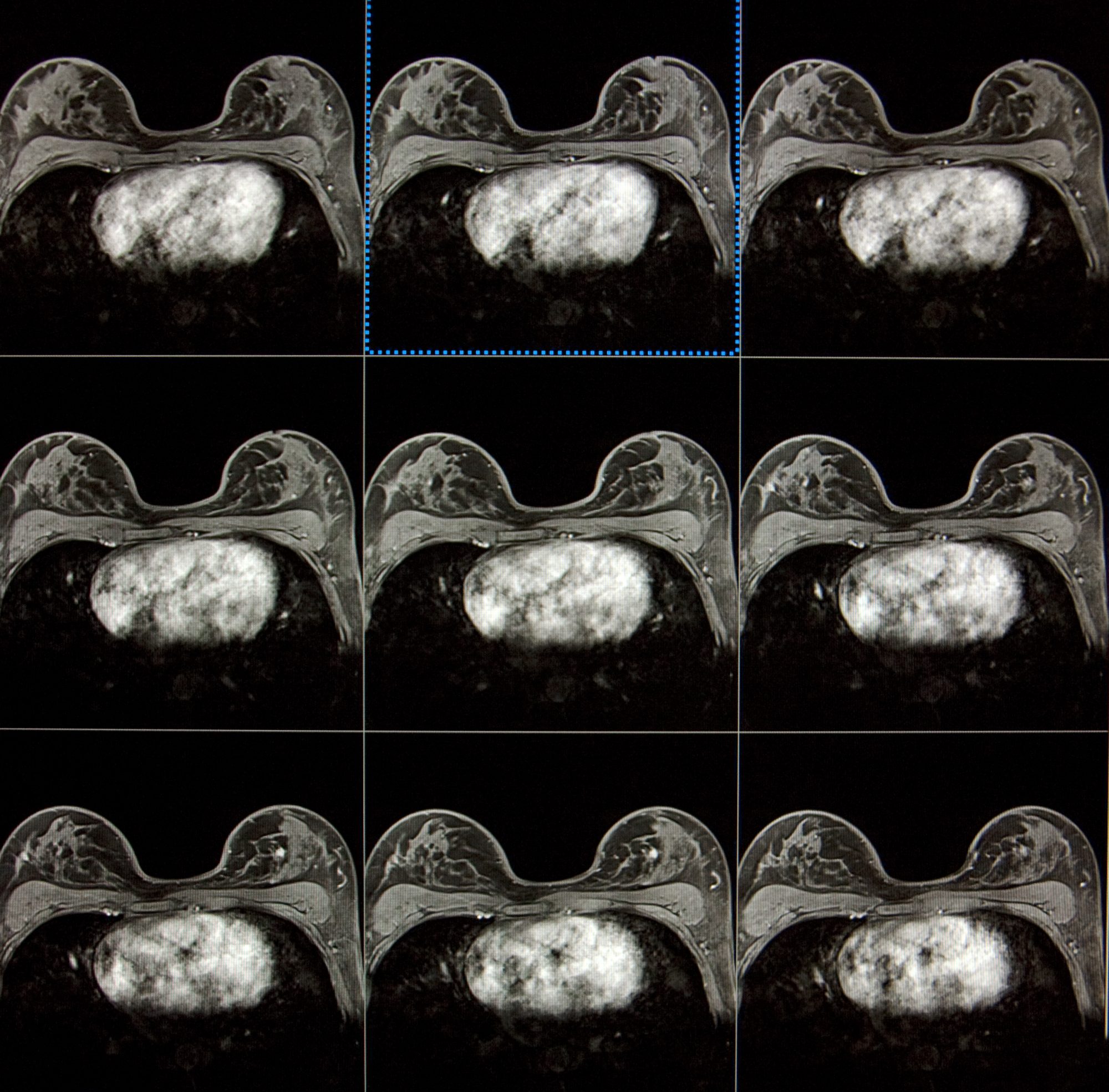 MRI image of a breast cancer patient