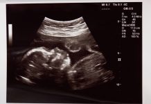 Ultrasound of foetus in the womb