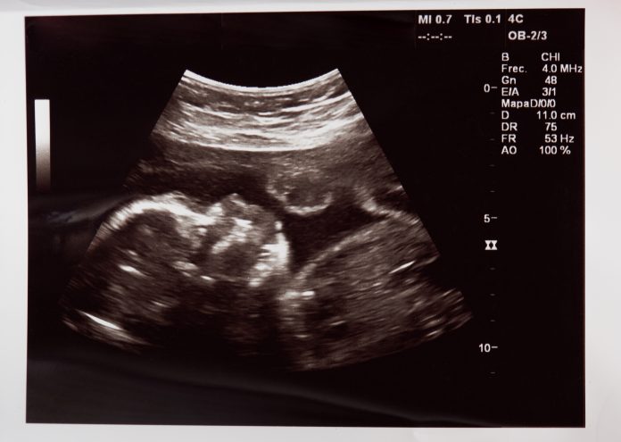 Ultrasound of foetus in the womb