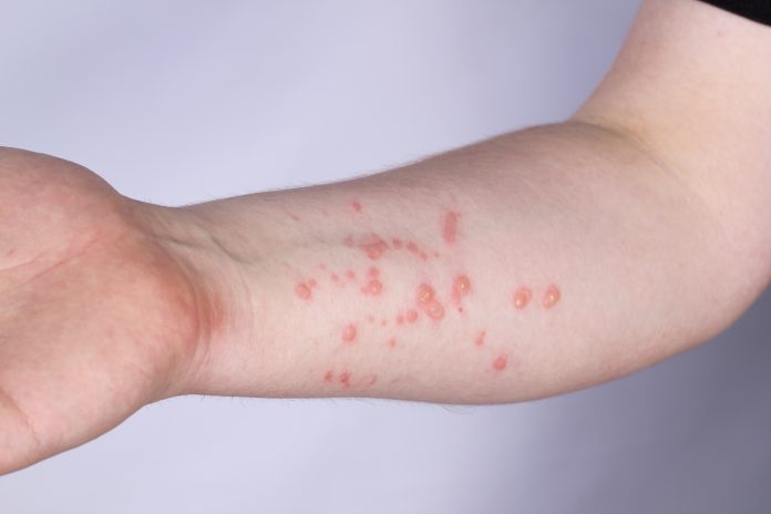 Large rash on a man's hand indicating the Monkeypox virus