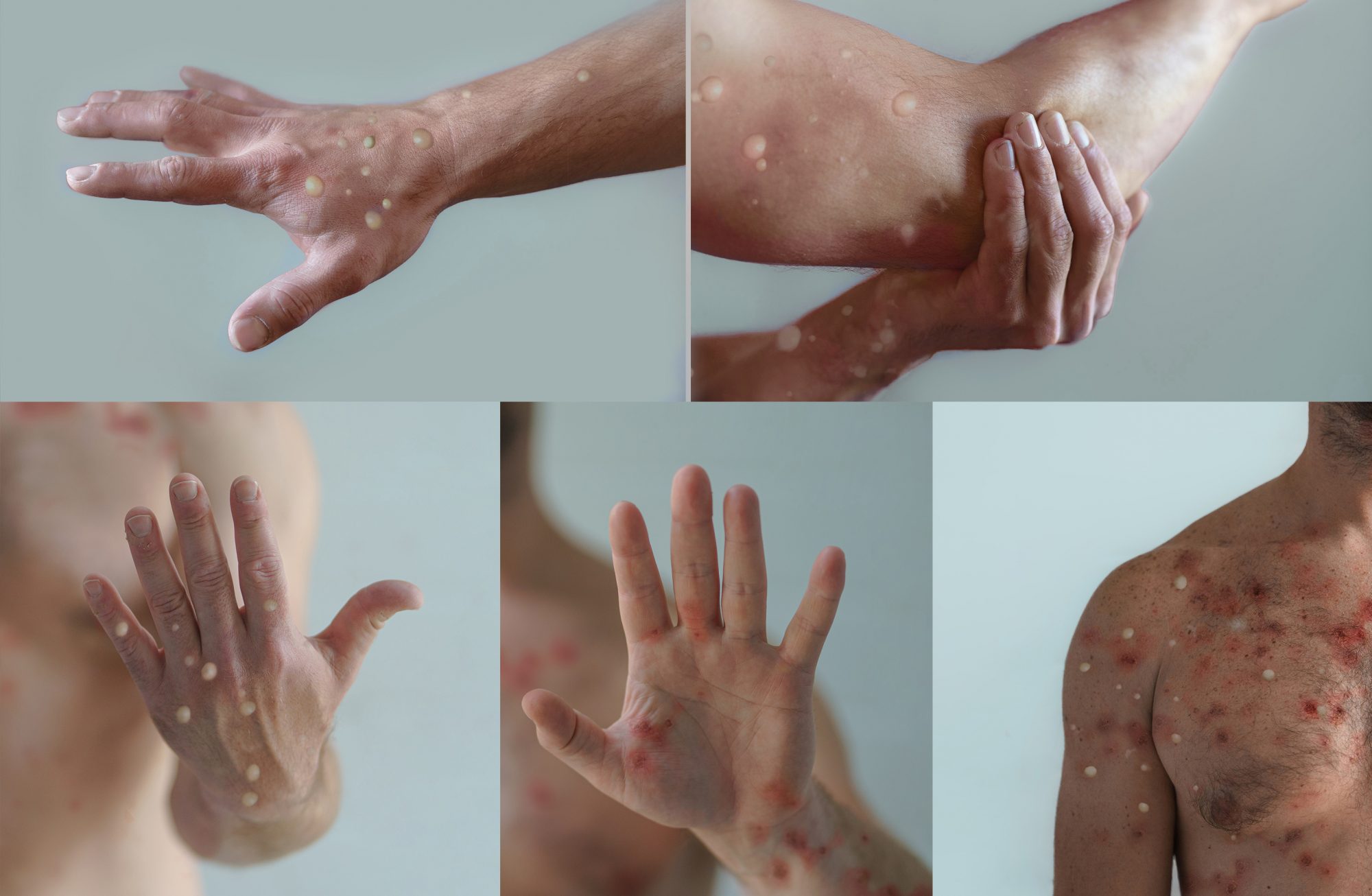 Male body parts affected by a blistering rash because of monkeypox or other viral infection