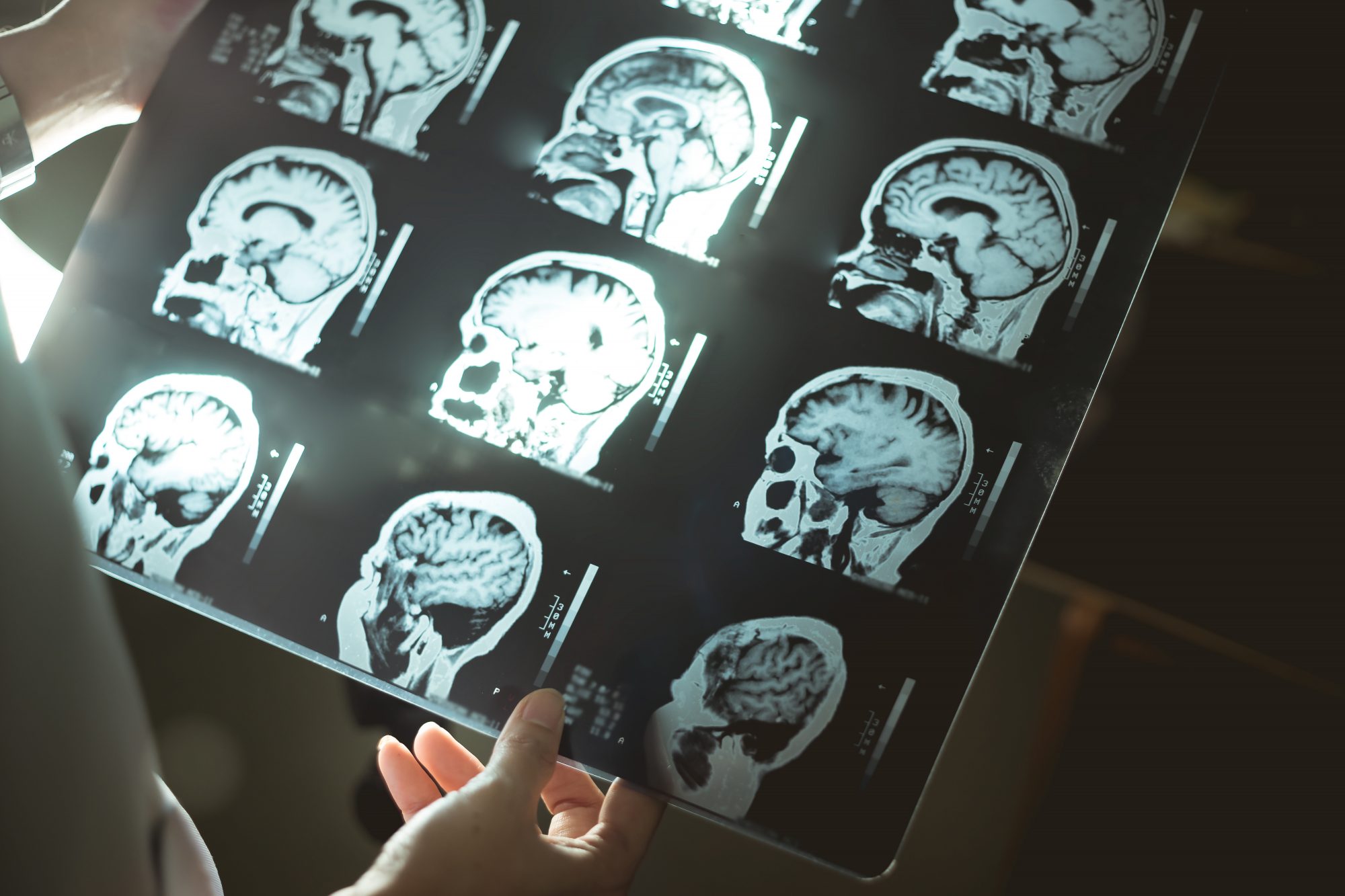 Brain MRI and dementia