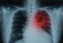 X-ray image showing cancer on lungs