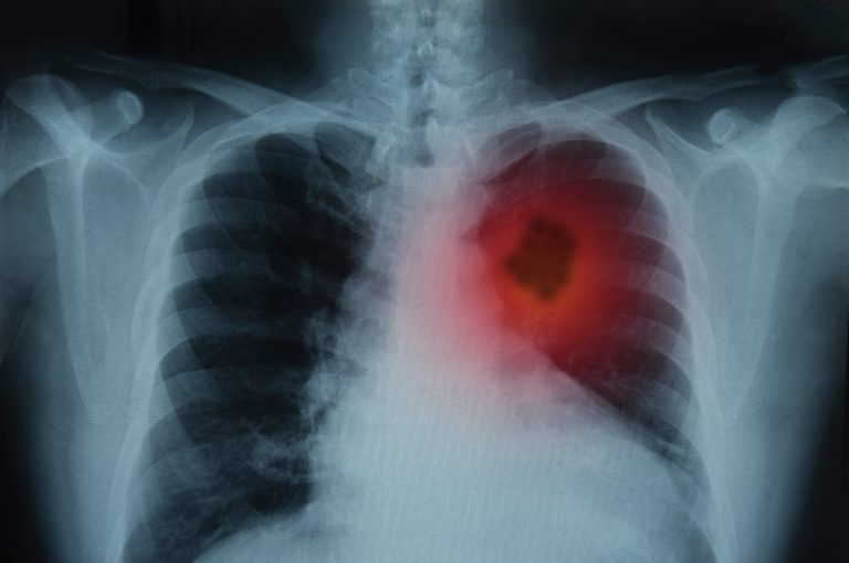 X-ray image showing cancer on lungs