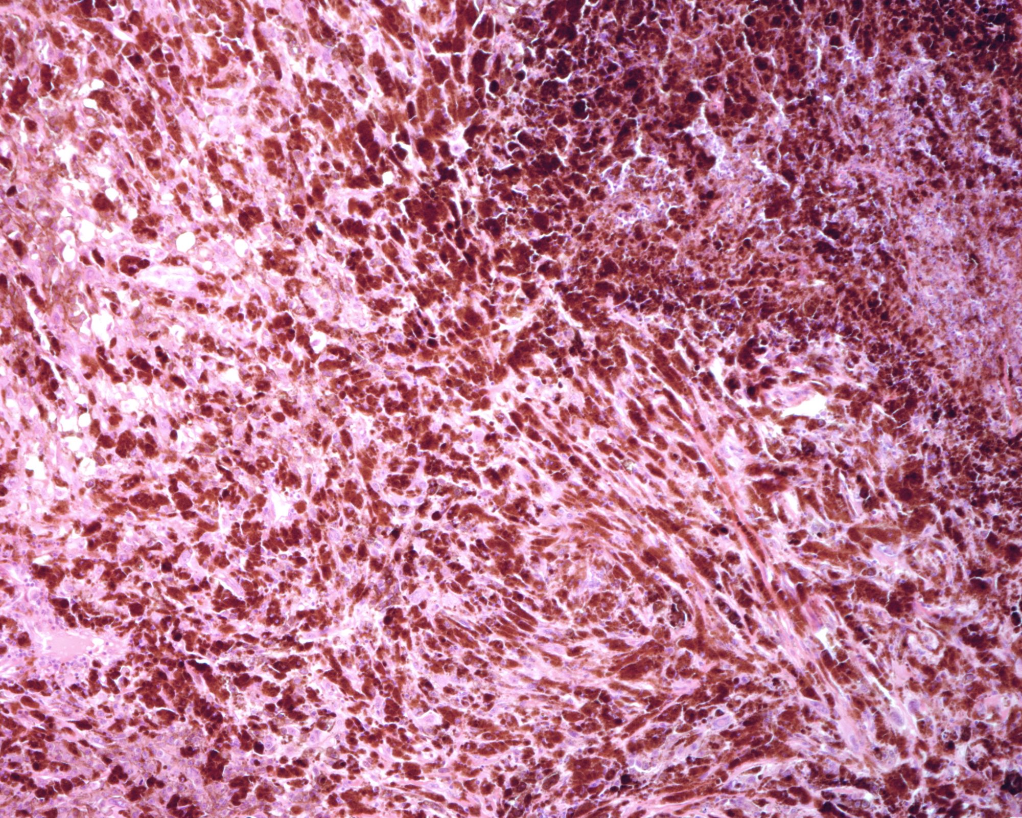 Human lymph node. Metastasis of malignant melanoma under a microscope