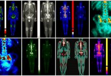Nuclear medicine scanning of patient with prostate cancer metastasis in areas of pelvis and spine in different colours