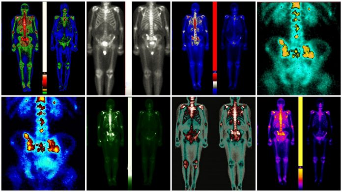 Nuclear medicine scanning of patient with prostate cancer metastasis in areas of pelvis and spine in different colours