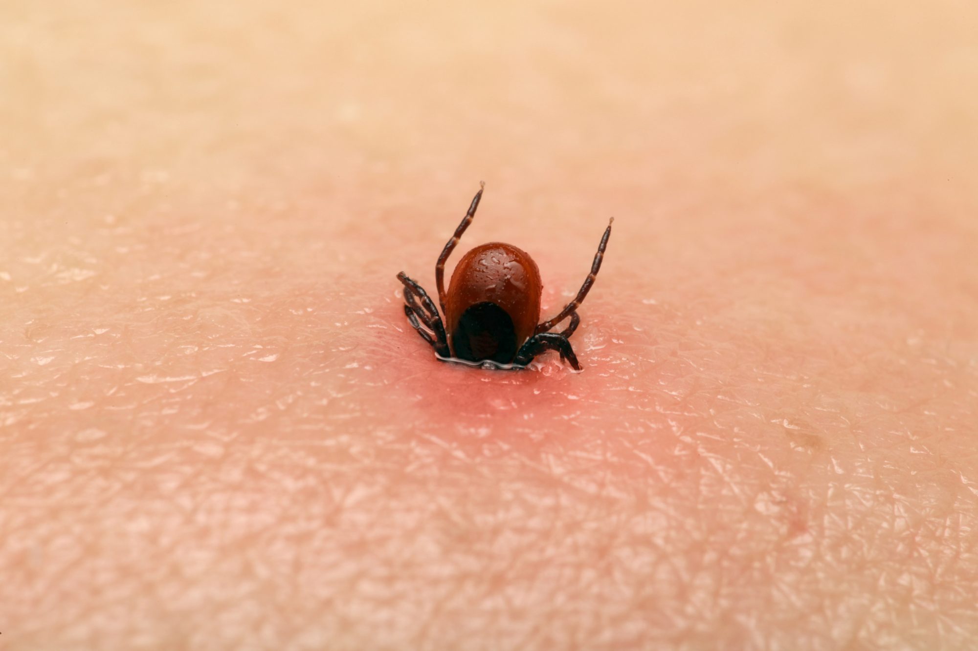 Tick embedding itself in skin