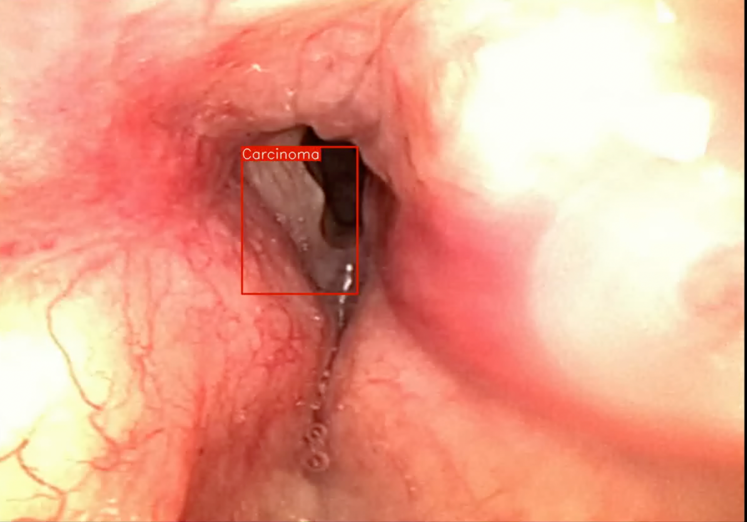 throat cancer detection