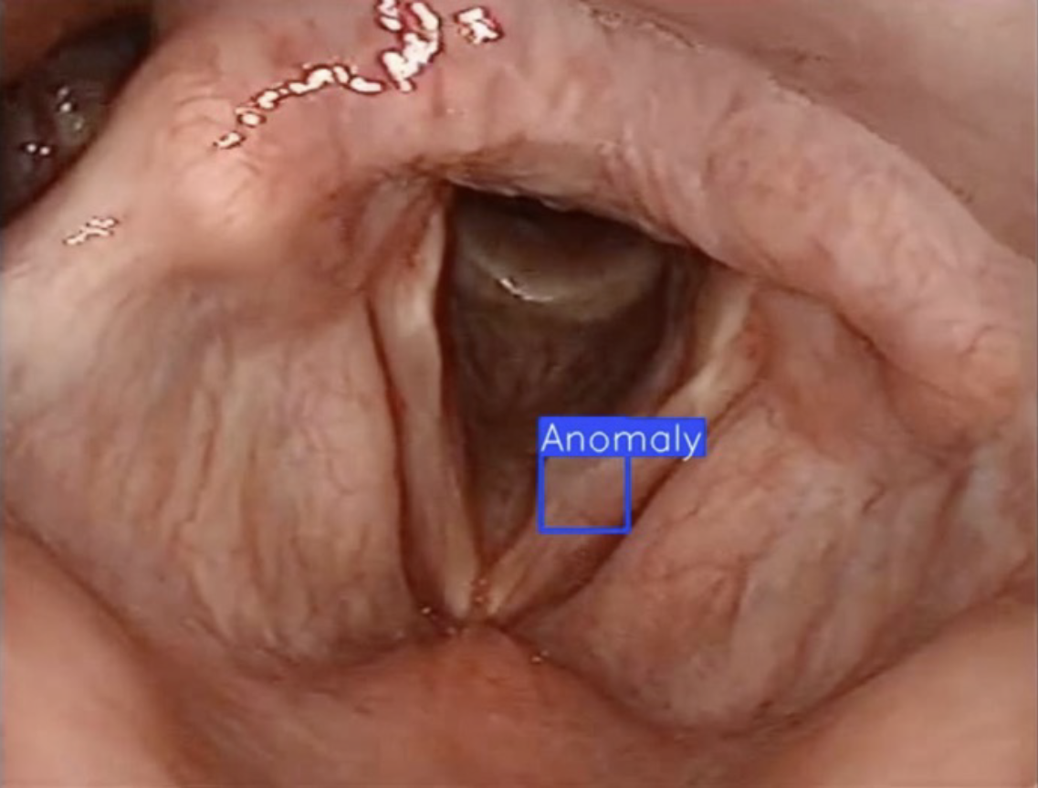 throat cancer detection, anomoly