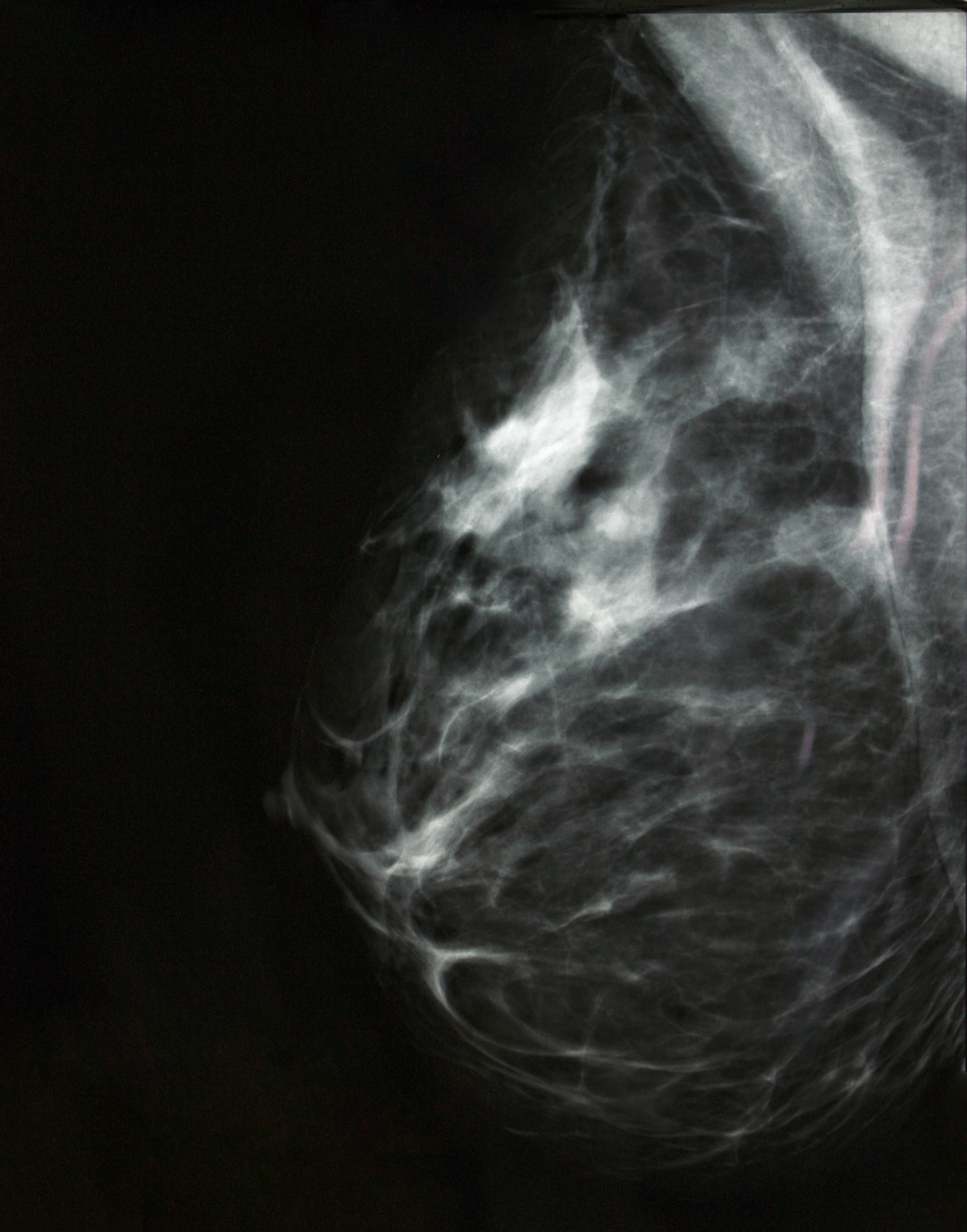 Digital mammography image, screening for breast cancer, radiology