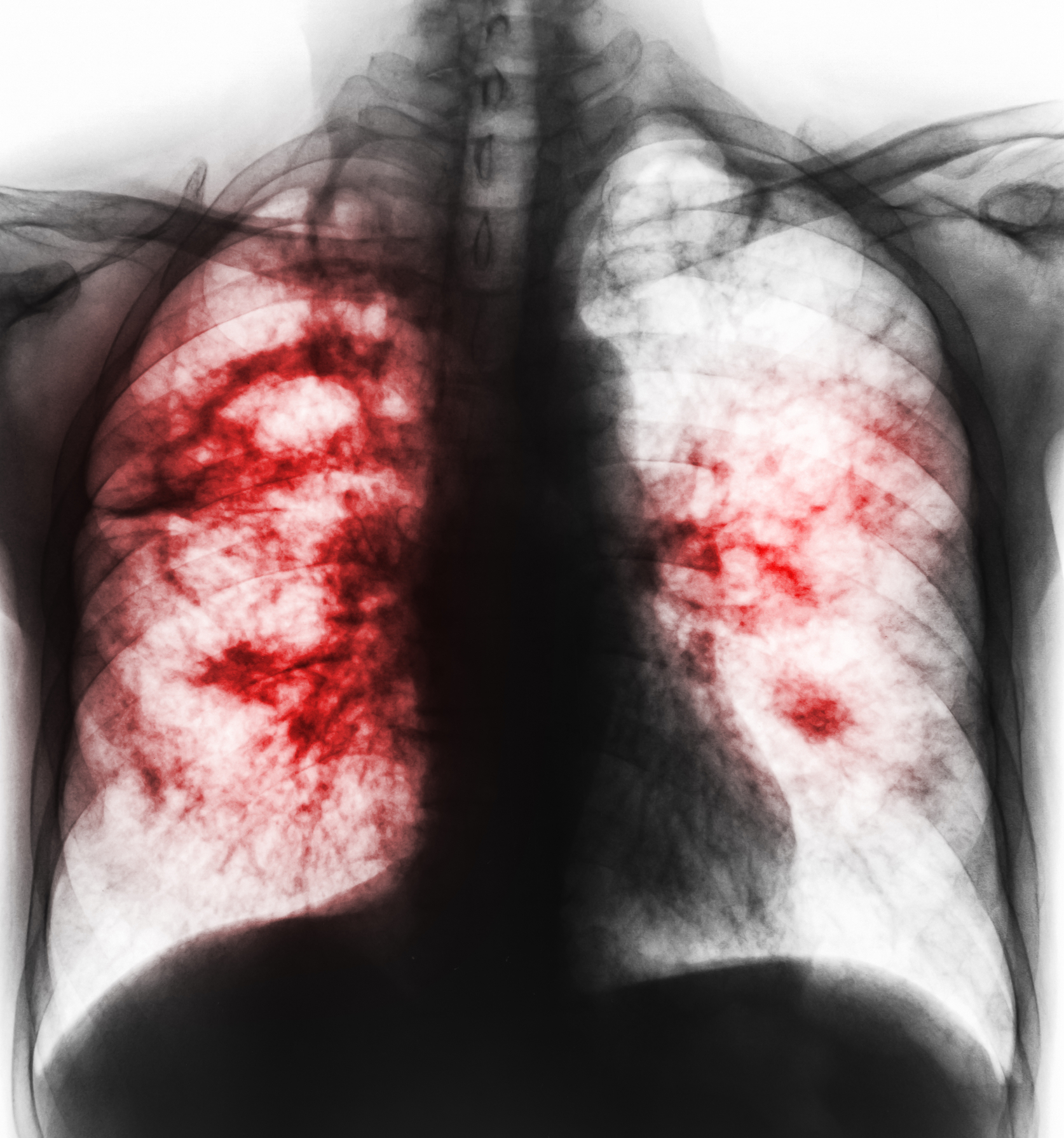 Pulmonary tuberculosis in a film x-ray of chest