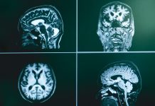 The epidemiology of Alzheimer’s - MRI brian of Dementia patient