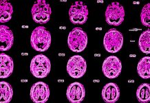 alzheimers, brain scan