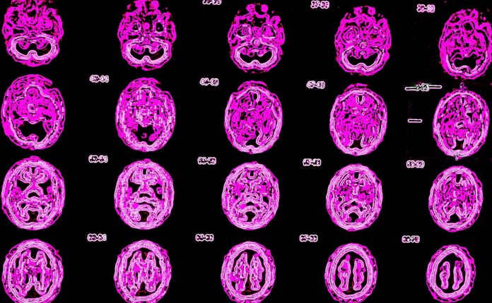 alzheimers, brain scan